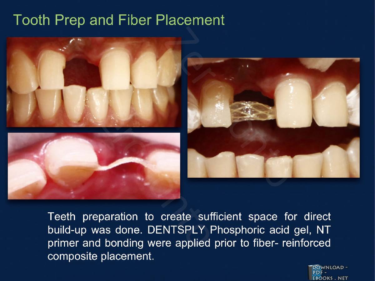 Martin A. Freilich Fiber-reinforced composites in clinical dentistry